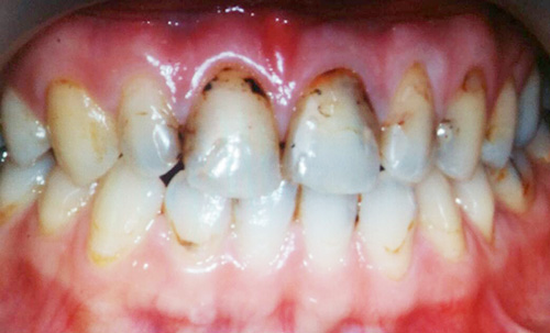 Before-CEREC3D4