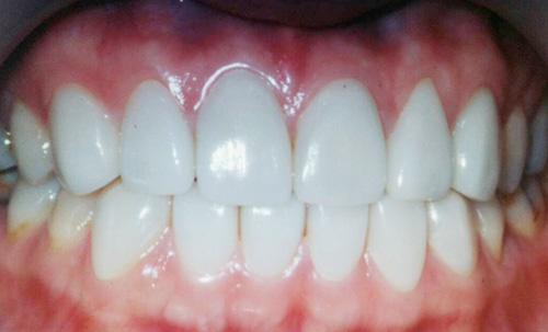 After-CEREC3D4