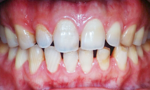 Before-CEREC3D5